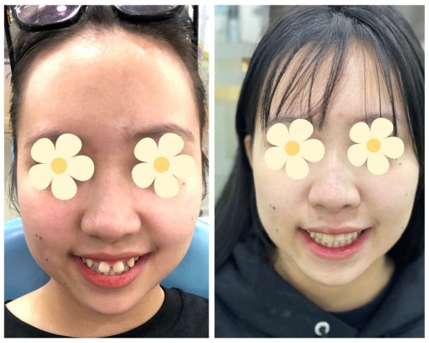 Hình ảnh của Chi trước và sau khi niềng răng