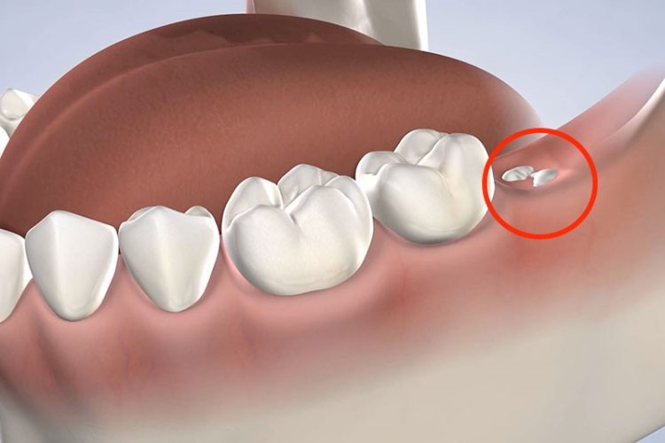 Răng khôn là răng mọc cuối cùng trên cung hàm