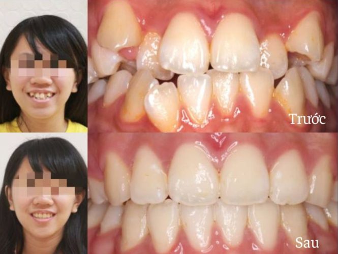 Hình ảnh của Thúy Ngân trước và sau khi niềng răng