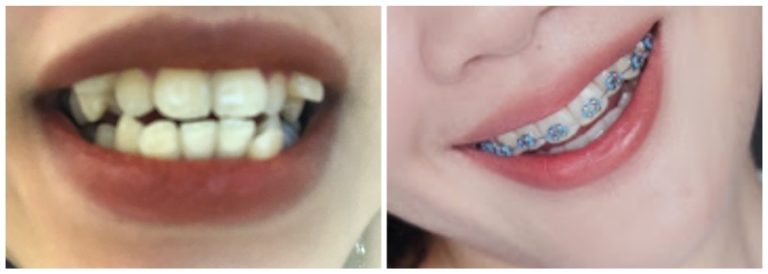 Hình ảnh của Linh trước và sau khi niềng răng