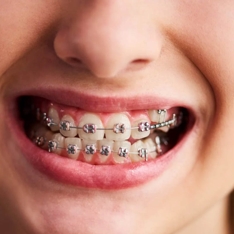 Các biến chứng niềng răng thường gặp xuất hiện do nhiều nguyên nhân