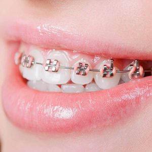 Nhiều người thắc mắc có nên niềng răng 1 hàm hay không
