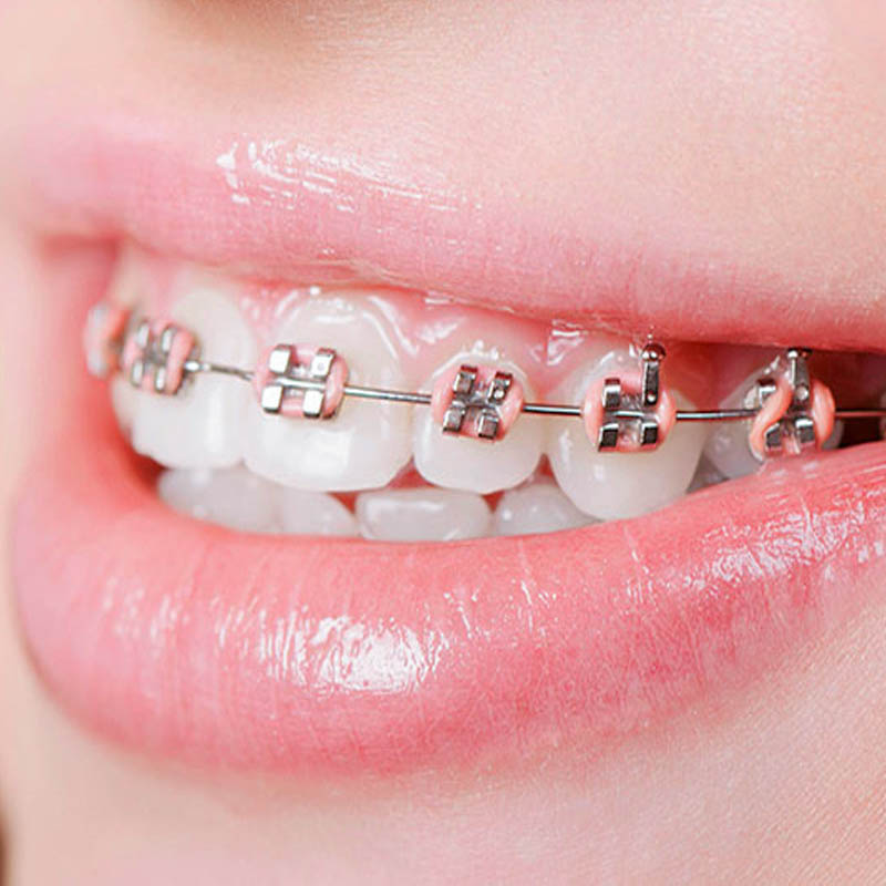 Nhiều người thắc mắc có nên niềng răng 1 hàm hay không