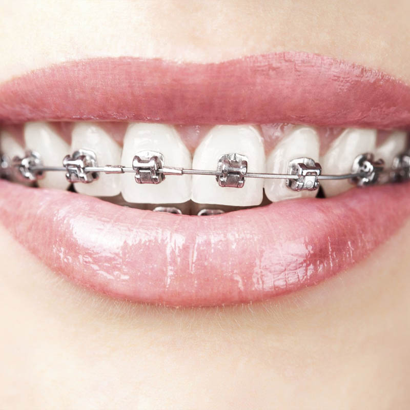 Niềng răng một hàm thực hiện cho trường hợp có khuyết điểm ở 1 hàm