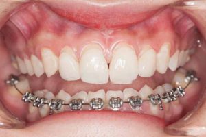 Giá niềng răng 1 hàm