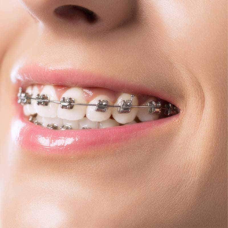 Niềng răng mắc cài kim loại đang rất phổ biến hiện nay