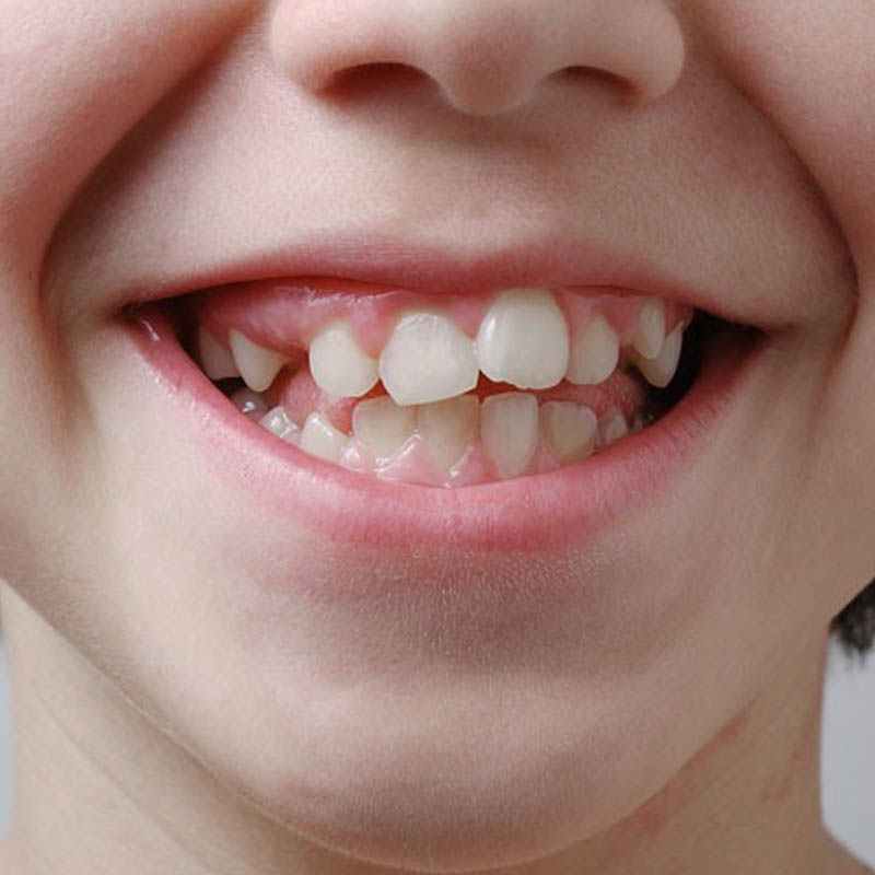 Mức độ sai lệch khớp cắn có ảnh hưởng đến giá niềng răng mắc cài kim loại