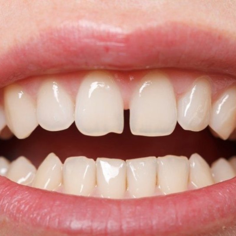 Đối tượng không nhất thiết phải nhổ răng khi niềng