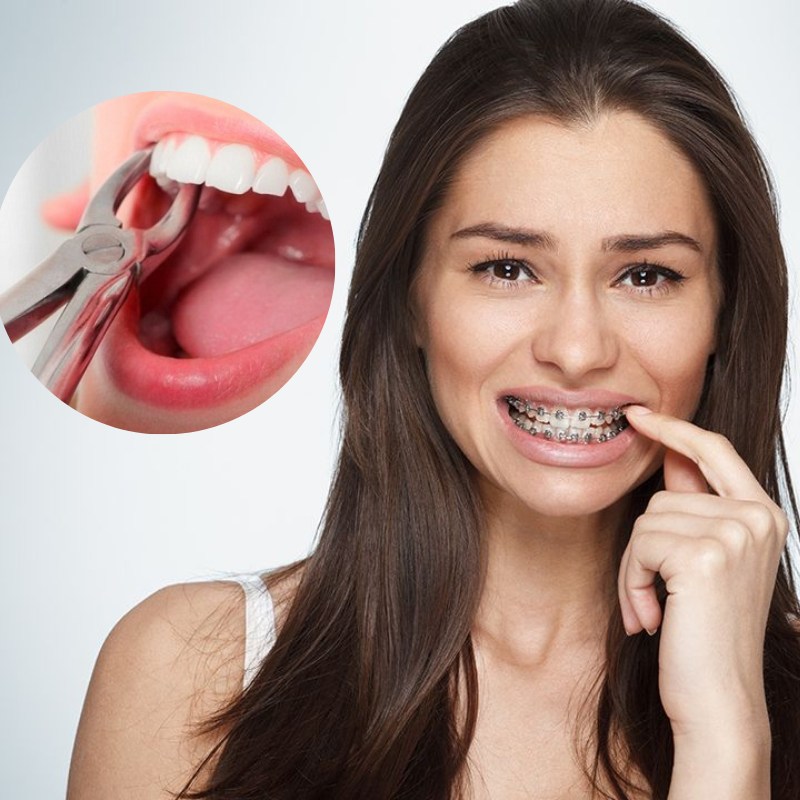 Niềng răng có phải nhổ răng không là thắc mắc của nhiều khách hàng