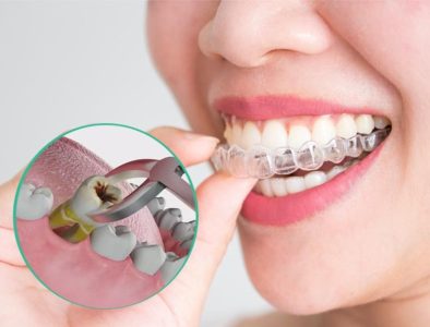 Niềng răng có phải nhổ răng không