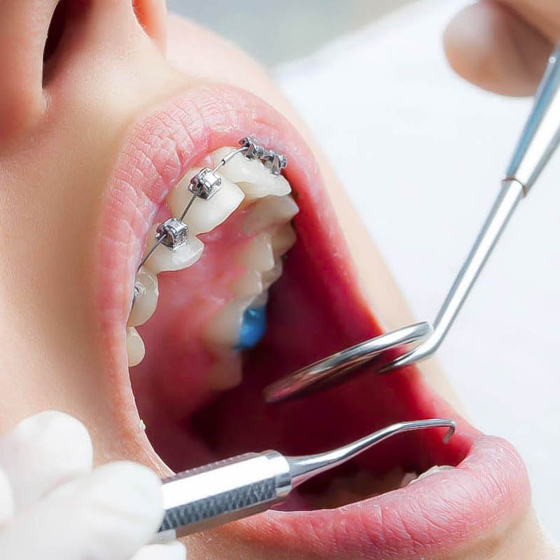 Quy trình niềng răng mắc cài thường gồm 7 bước