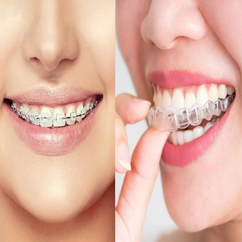 So sánh niềng răng mắc cài và Invisalign có nhiều điểm khác biệt