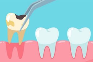 Niềng Răng Có Phải Nhổ Răng Khôn Không? Chuyên Gia Giải Đáp