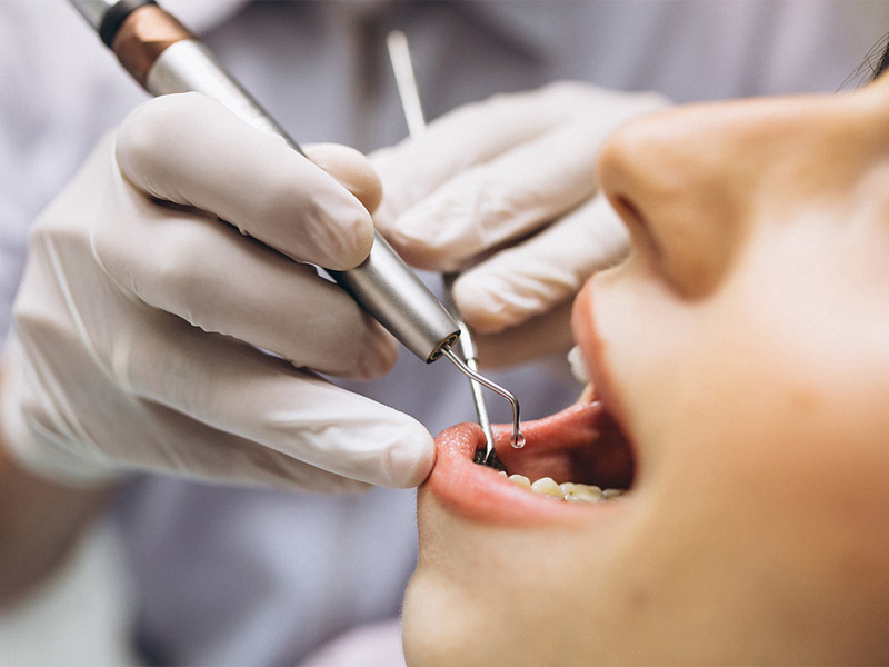 Niềng răng có thể phải nhổ răng để tạo khoảng trống cho răng khác dịch chuyển