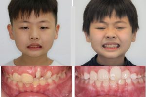 Hình ảnh trước - sau khi niềng răng
