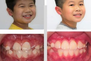 Hình ảnh trước và sau khi niềng răng bác sĩ Thái