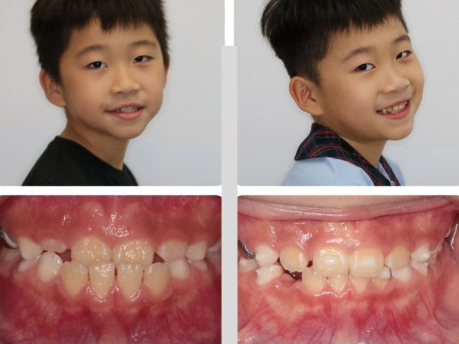 Hình ảnh khách hàng trước và sau khi niềng răng