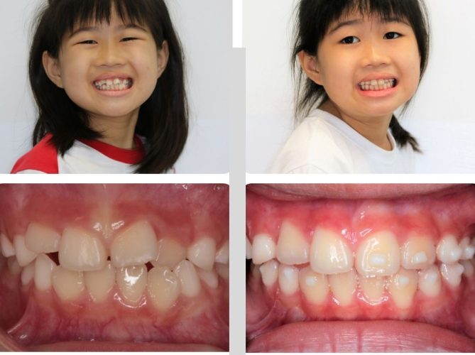 Hình ảnh của khách hàng trước và sau khi niềng răng
