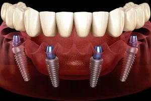 Trồng Răng Implant