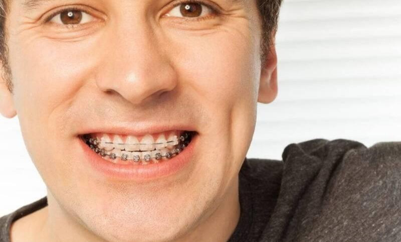 Sau 35 tuổi cần ít nhất 2 năm để răng dịch chuyển về đúng vị trí