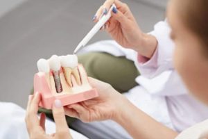 Chăm Sóc Răng Sau Khi Cắm Implant - Chuyên Gia Chia Sẻ