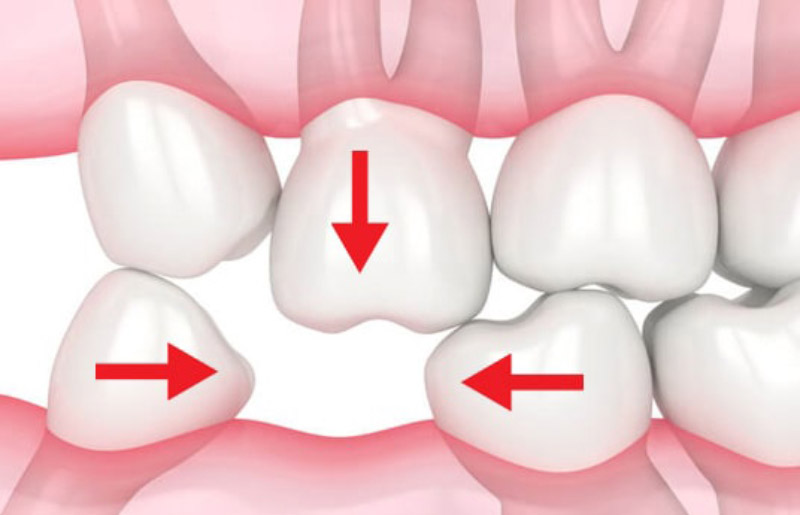 Khi trong hàm có chỗ trống, các răng còn lại sẽ gây ra hiện tượng xô lệch