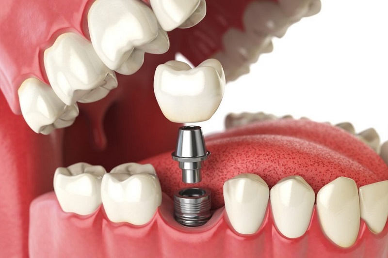 Trồng răng Implant là phương pháp khắc phục mất răng lâu năm