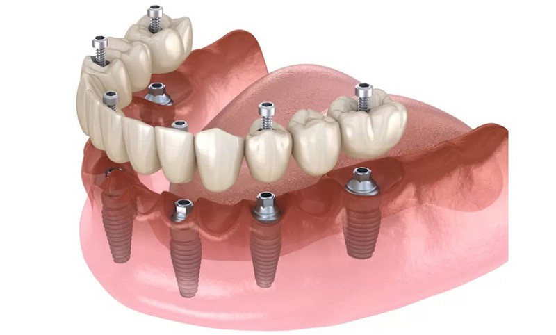 Cấy ghép Implant là giải pháp phục hình răng hoàn hảo nhất