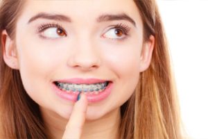 Bác Sĩ Giải Đáp: Niềng Răng Có Làm Răng Yếu Đi Không?