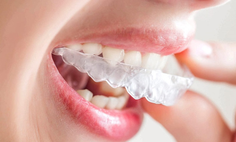 Niềng răng Invisalign chắc chắn sẽ gây ê nhức khó chịu