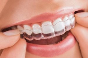 Niềng Răng Invisalign Có Đau Không - Chuyên Gia Giải Đáp