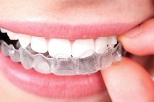 Giải Đáp: Niềng Răng Invisalign Mất Bao Lâu Thì Răng Đều Đẹp?
