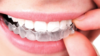 Giải Đáp: Niềng Răng Invisalign Mất Bao Lâu Thì Răng Đều Đẹp?