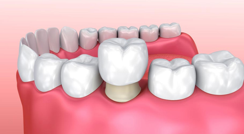 Bọc răng sứ được áp dụng để cải thiện thẩm mỹ cho các trường hợp răng khấp khểnh