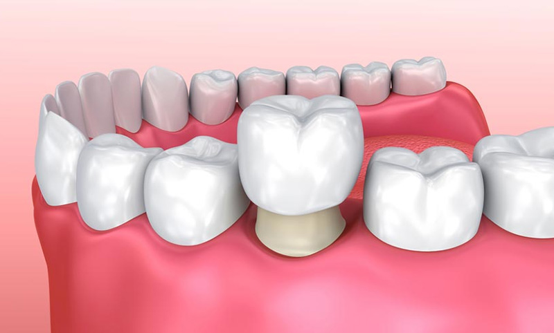 Bọc răng sứ được áp dụng với trường hợp móm răng nhẹ