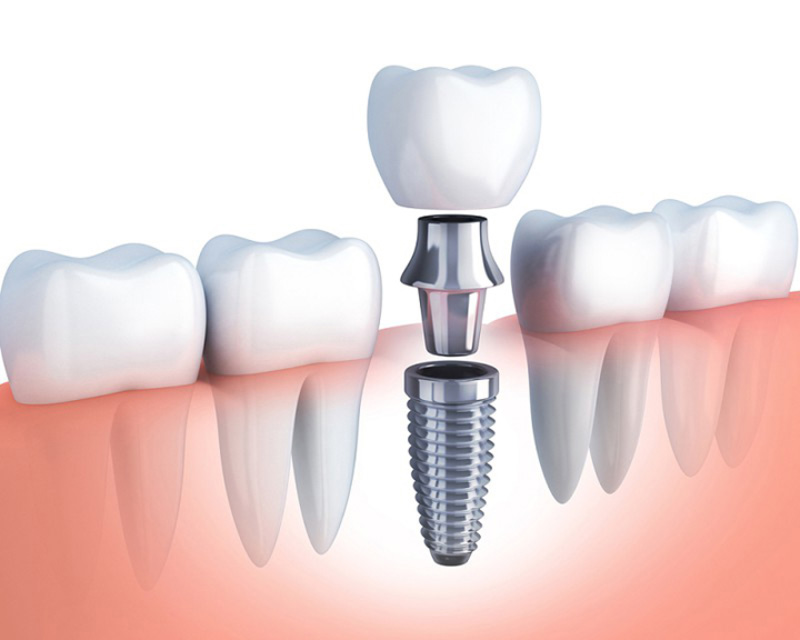 Không phải tất cả các trường hợp mất răng đều được cấy ghép răng Implant