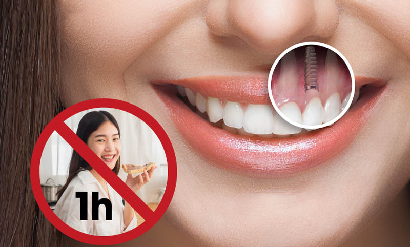 Không nên ăn uống trong 1 giờ đầu sau khi trồng răng Implant