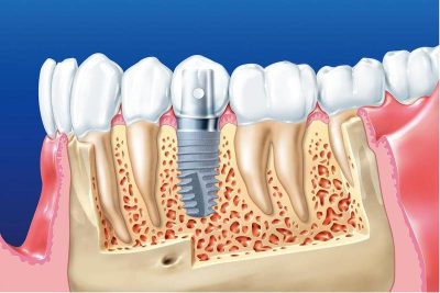 Trồng Răng Implant Có Được Bảo Hiểm Không