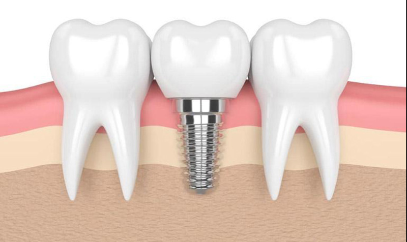 Độ bền của răng Implant phụ thuộc vào chất lượng trụ và mão sứ