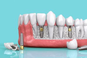 Trồng Răng Implant Mất Bao Lâu? Cách Rút Ngắn Thời Gian