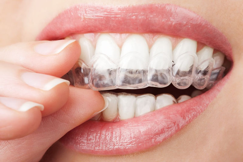 Niềng răng trong suốt Invisalign là phương pháp hiện đại nhất hiện nay