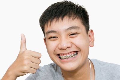 15, 16, 17 Tuổi Niềng Răng Bao Nhiêu Tiền? Các Tiết Kiệm Chi Phí