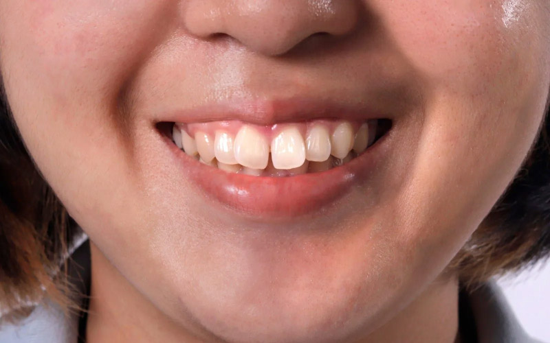 Tình trạng răng ảnh hưởng tới mức chi phí