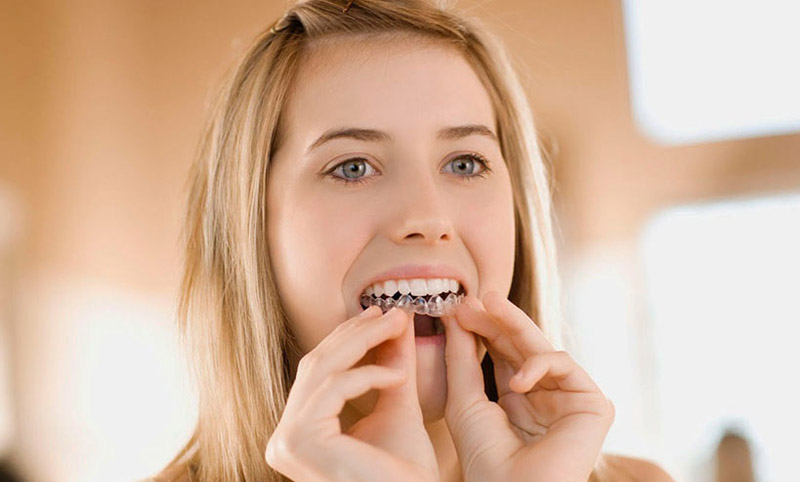 25 đến 30 tuổi vẫn có thể niềng răng như bình thường
