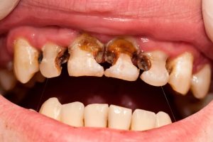Sâu răng do chăm sóc không đúng cách