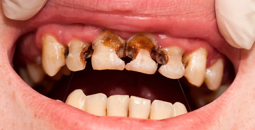 Sâu răng do chăm sóc không đúng cách