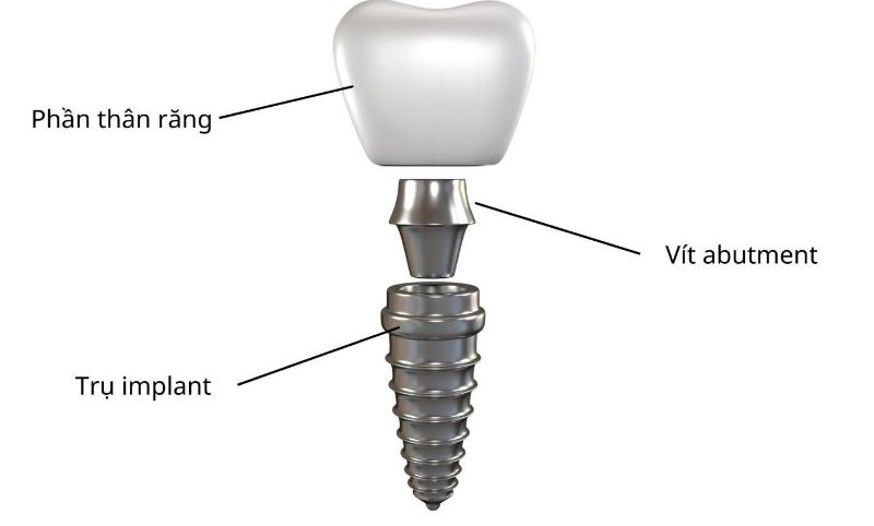 Abutment Implant có hình trụ, là phần kết nối mão sứ ở trên và Implant ở dưới