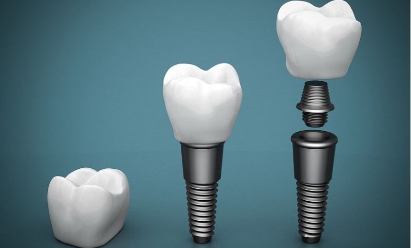 Chất liệu thường được dùng để tạo ra Abutment Implant là Titan hoặc kim loại quý