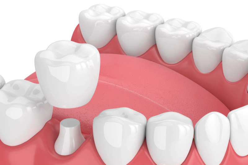 Độ thành công của bọc răng sứ phụ thuộc vào độ tuổi của người thực hiện
