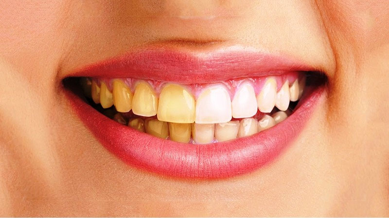 Bọc răng sứ khắc phục tình trạng răng ố vàng